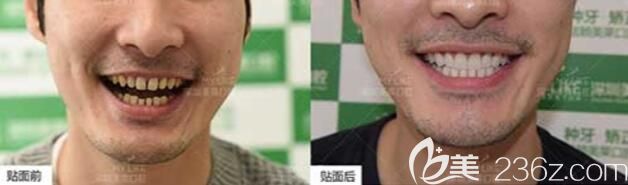 深圳美萊口腔怎么樣？真人牙齒矯正+瓷貼面修復(fù)案例效果及反饋來驗(yàn)證