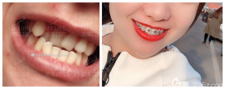 美萊口腔牙齒擁擠不齊矯正案例前后對對比照片