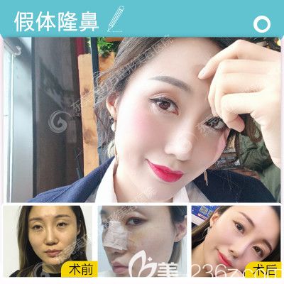 東莞美立方宋兆丹做海鷗隆鼻案例