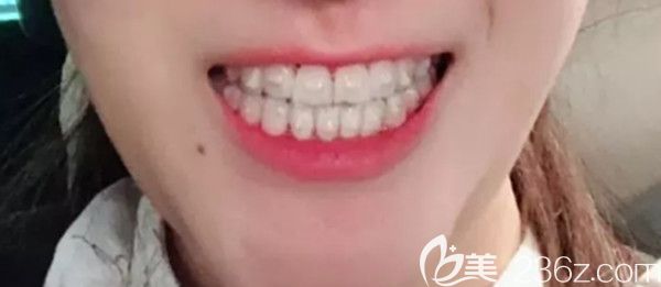 戴牙套的第十個月變化圖