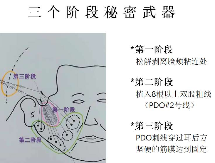 樸明旭院長分階段埋線提升示意圖