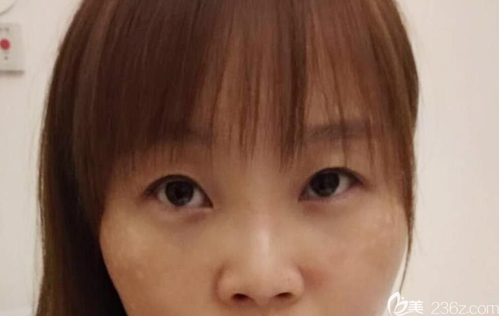 找合肥壹加壹<!--<i data=20240703-sp></i>-->做眼綜合+鼻綜合術(shù)前照 找合肥壹加壹<!--<i data=20240703-sp></i>-->做眼綜合+鼻綜合術(shù)前照