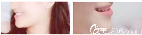 隱形牙套前后側臉及下巴對比照片