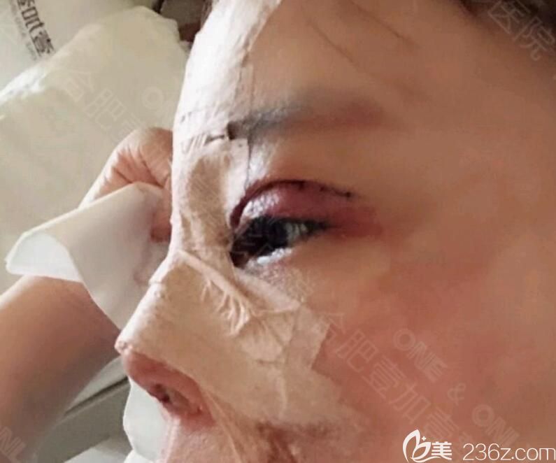 <!--<i data=20240703-sp></i>-->院長做膨體軟骨隆鼻+眼綜合術(shù)后第1天 <!--<i data=20240703-sp></i>-->院長做膨體軟骨隆鼻+眼綜合術(shù)后第1天