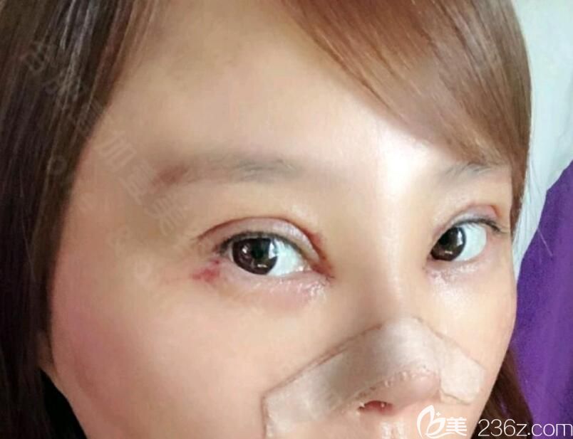 壹加壹整形眼鼻綜合術(shù)后第10天 壹加壹整形眼鼻綜合術(shù)后第10天