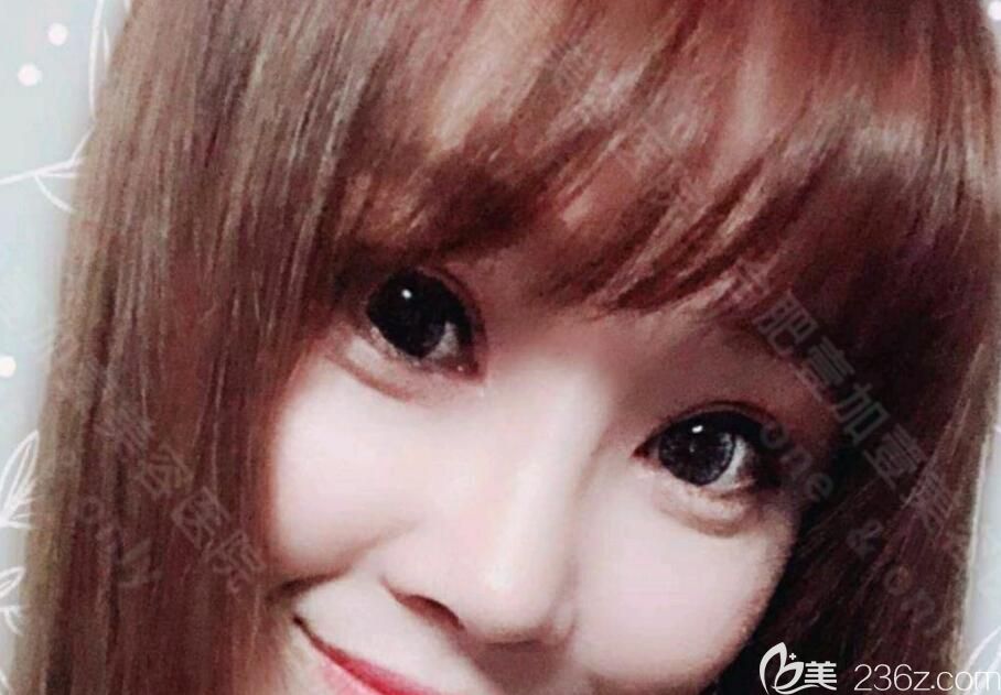 隆鼻失敗修復(fù)+眼綜合術(shù)后第25天恢復(fù)情況 隆鼻失敗修復(fù)+眼綜合術(shù)后第25天恢復(fù)情況