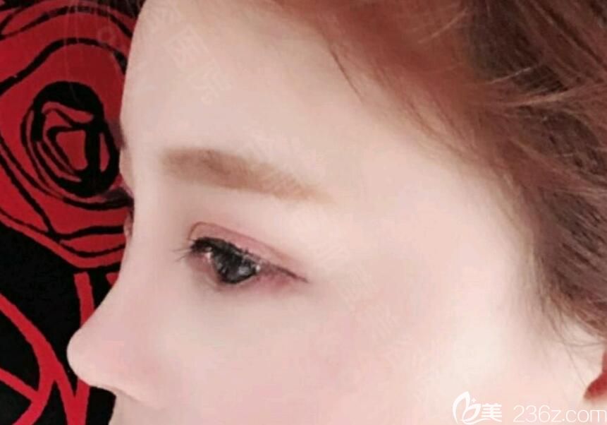 體驗(yàn)了合肥壹加壹整形的激光祛斑之后，才找院長做了膨體軟骨鼻綜合隆鼻+眼綜合手術(shù)，曬35天效果