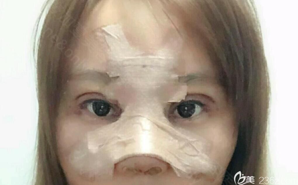 合肥壹加壹隆鼻失敗修復(fù)+眼綜合術(shù)后第7天 合肥壹加壹隆鼻失敗修復(fù)+眼綜合術(shù)后第7天