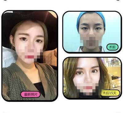 洛陽毛大夫雙眼皮前后對比照片