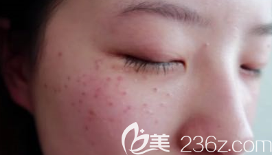 濰坊皮秒祛斑術(shù)后第4天的樣子