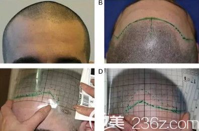 余繼平醫(yī)生為我做植發(fā)前設(shè)計(jì)