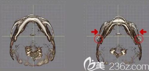 韓國(guó)面部輪廓三件套改善部位 韓國(guó)面部輪廓三件套改善部位