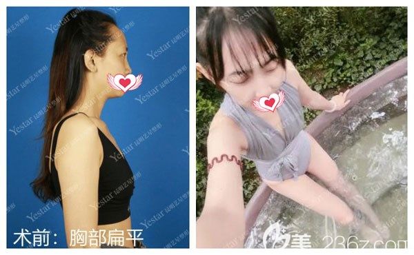 在昆明藝星假體隆胸手術(shù)前 在昆明藝星假體隆胸手術(shù)前