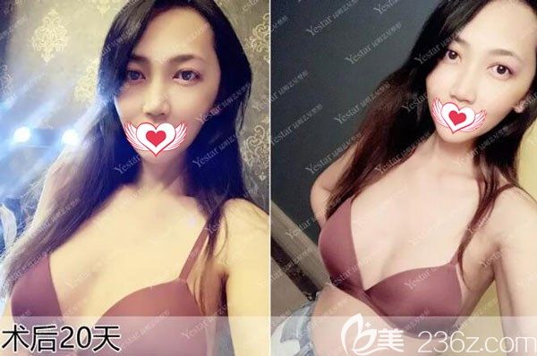 公布昆明藝星金輝做硅膠假體豐胸案例效果對(duì)比圖,來揭曉隆胸假體會(huì)不會(huì)出現(xiàn)移位