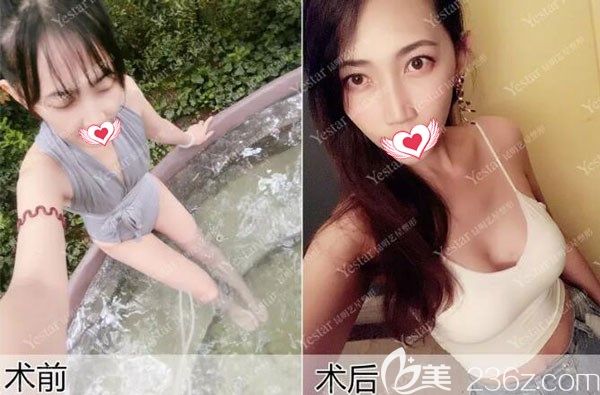 硅膠隆胸三個(gè)月前后效果對比圖 硅膠隆胸三個(gè)月前后效果對比圖