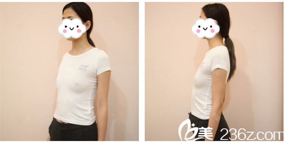 在廣州美萊做隆胸術(shù)前照片 在廣州美萊做隆胸術(shù)前照片
