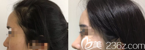 我的假體隆鼻術(shù)前后的對比照片