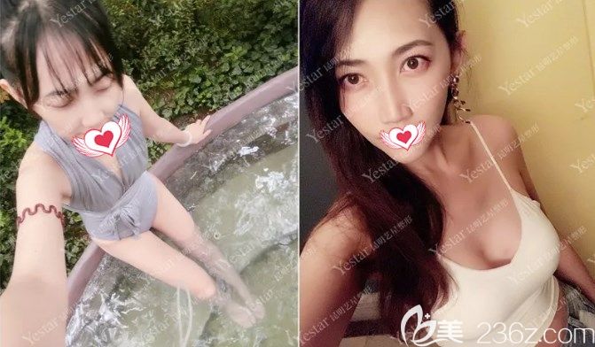 金輝做自體脂肪豐胸案例效果對比圖 金輝做自體脂肪豐胸案例效果對比圖