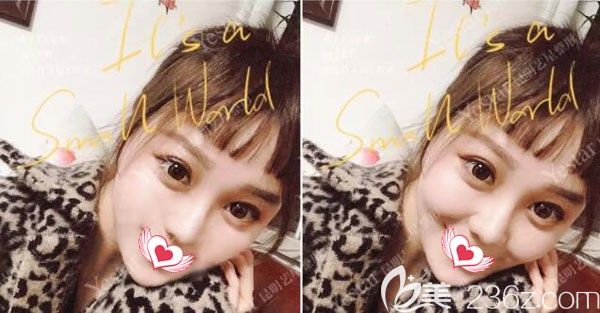 應(yīng)許做自體脂肪面部填充蘋果肌案例效果 應(yīng)許做自體脂肪面部填充蘋果肌案例效果