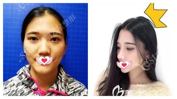 做自體軟骨隆鼻+硅膠隆鼻案例效果 做自體軟骨隆鼻+硅膠隆鼻案例效果