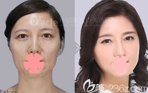 長(zhǎng)春中妍奧拉克金學(xué)周面部年輕化前后效果對(duì)比圖 長(zhǎng)春中妍奧拉克金學(xué)周面部年輕化前后效果對(duì)比圖