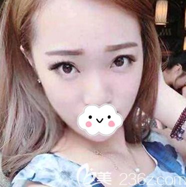 術(shù)前單眼皮塌鼻梁照片 術(shù)前單眼皮塌鼻梁照片