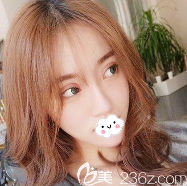 李瑞醫(yī)生雙眼皮隆鼻案例15天恢復(fù)效果圖 李瑞醫(yī)生雙眼皮隆鼻案例15天恢復(fù)效果圖