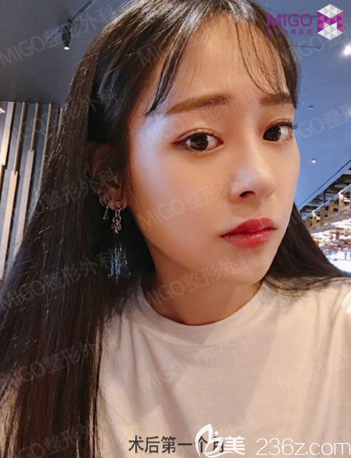 韓國migo姜垠宅硅膠隆鼻+埋線雙眼皮3個(gè)月后看看我的變化，自己都吃驚