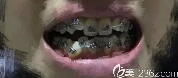 剛帶上金屬牙套的照片 剛帶上金屬牙套的照片