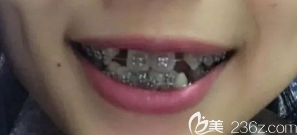 拔牙后帶上金屬牙套的樣子 拔牙后帶上金屬牙套的樣子