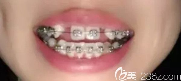 金屬托槽矯正半個月的效果圖 金屬托槽矯正半個月的效果圖