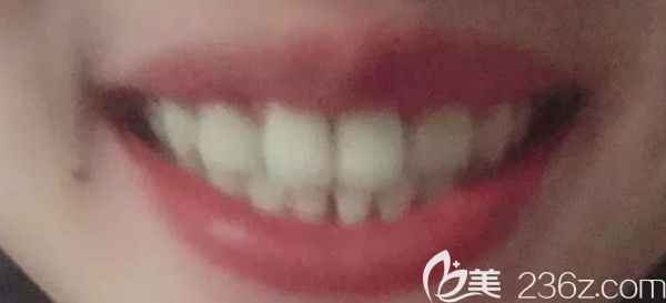 在西安中諾口腔用2年的時間完成了牙齒矯正，期間做了瓷貼面，公布正畸前后變化圖