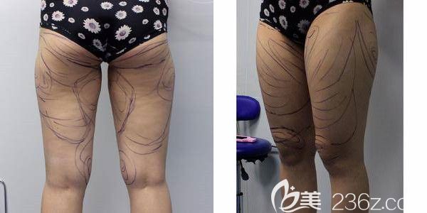 面診蘇州紫馨術前大腿較粗 面診蘇州紫馨術前大腿較粗