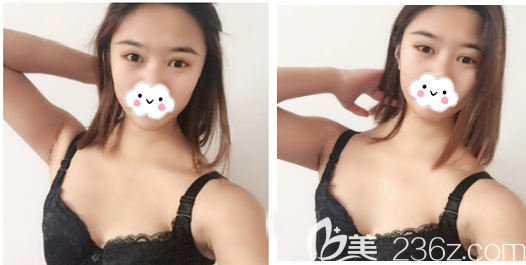 在佛山華美做隆胸術(shù)前照片 在佛山華美做隆胸術(shù)前照片