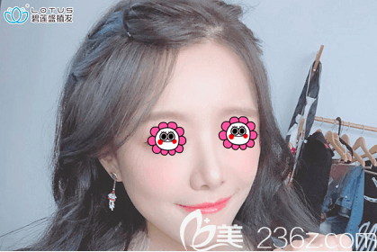 我在北京植發(fā)醫(yī)院排名靠前的北京碧蓮盛種植發(fā)際線后改善了額角光禿等問題