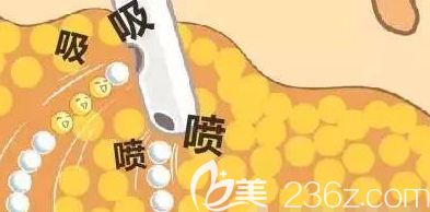 吸脂手術(shù)的原理 吸脂手術(shù)的原理