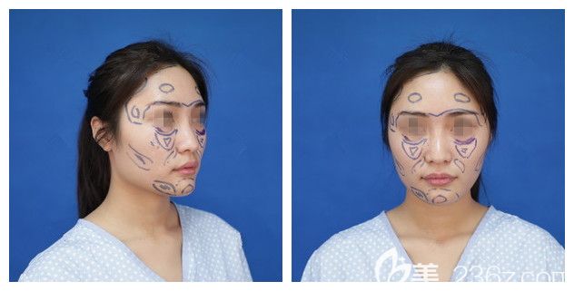 除了做鼻子之外術(shù)前脂肪填充區(qū)域的劃線設(shè)計(jì) 除了做鼻子之外術(shù)前脂肪填充區(qū)域的劃線設(shè)計(jì)