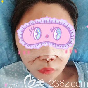 剛做完鼻綜合+脂肪填充術(shù)后恢復(fù) 剛做完鼻綜合+脂肪填充術(shù)后恢復(fù)