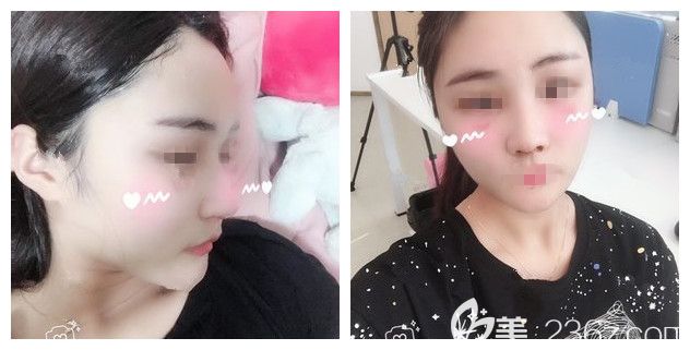 脂肪填充+鼻綜合術(shù)后半個(gè)月恢復(fù) 脂肪填充+鼻綜合術(shù)后半個(gè)月恢復(fù)