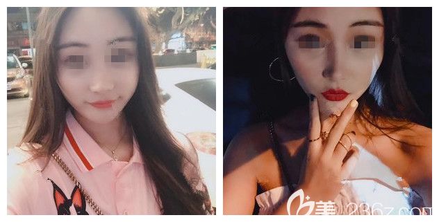 看過鼻整形價格表后在做了進口韓式生科硅膠隆鼻+耳軟骨鼻尖塑型鼻綜合，還捎帶在面部填充了脂肪