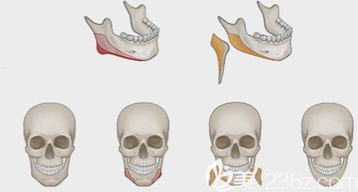 下頜角切除手術(shù)示意圖