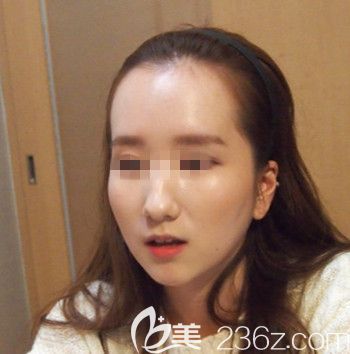 在韓國forhair做無切開發(fā)際線移植術(shù)前咨詢 在韓國forhair做無切開發(fā)際線移植術(shù)前咨詢