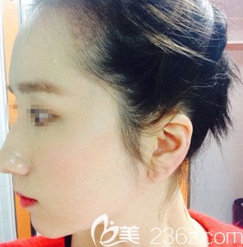 在韓國forhair做無切開發(fā)際線移植術(shù)后3個(gè)月 在韓國forhair做無切開發(fā)際線移植術(shù)后3個(gè)月