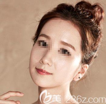 天生額頭寬？來看一下我選擇韓國forhair做無切開發(fā)際線移植的手術(shù)1年恢復(fù)過程