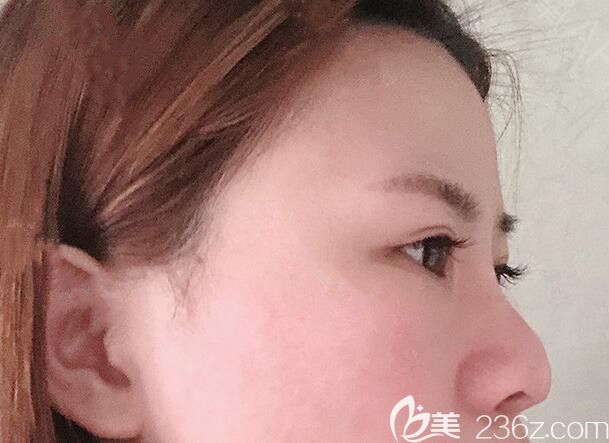 我在太原時(shí)光整形做鼻綜合前的照片 我在太原時(shí)光整形做鼻綜合前的照片