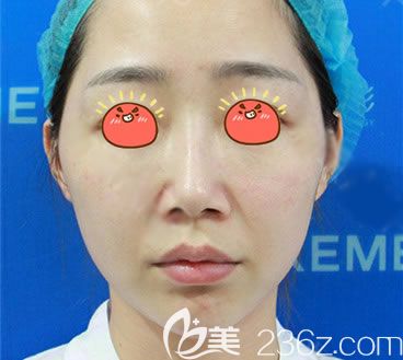 做自體脂肪填充全臉之前 做自體脂肪填充全臉之前