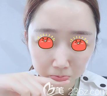 做完自體脂肪填充4天恢復圖片 做完自體脂肪填充4天恢復圖片