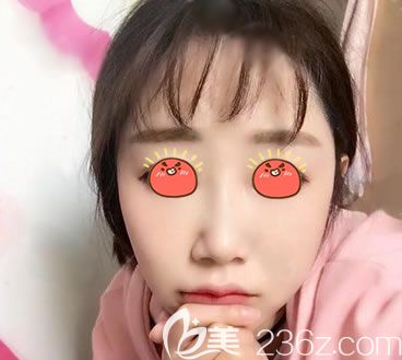 義烏連天美自體脂肪填充3個月<span style= 義烏連天美自體脂肪填充3個月<span style=