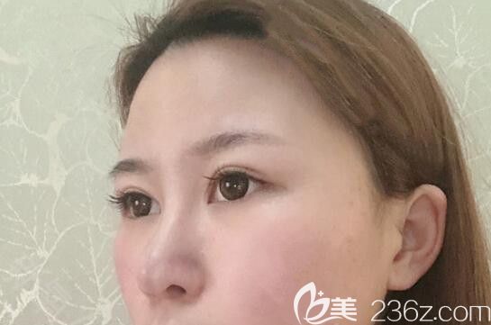 我在太原時(shí)光整形做鼻綜合隆鼻術(shù)后第15天 我在太原時(shí)光整形做鼻綜合隆鼻術(shù)后第15天
