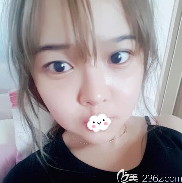 韓國eu整形外科金鐘潤顴骨降低+長曲線下頜角術(shù)后7天恢復(fù)照片 韓國eu整形外科金鐘潤顴骨降低+長曲線下頜角術(shù)后7天恢復(fù)照片